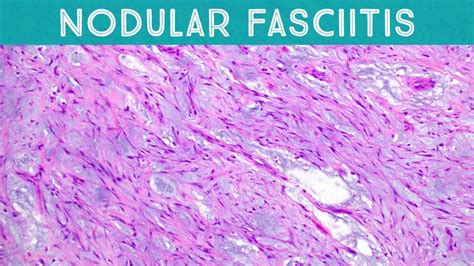 noduläre fasziitis|Nodular Fasciitis: Pathology, Causes & Treatment